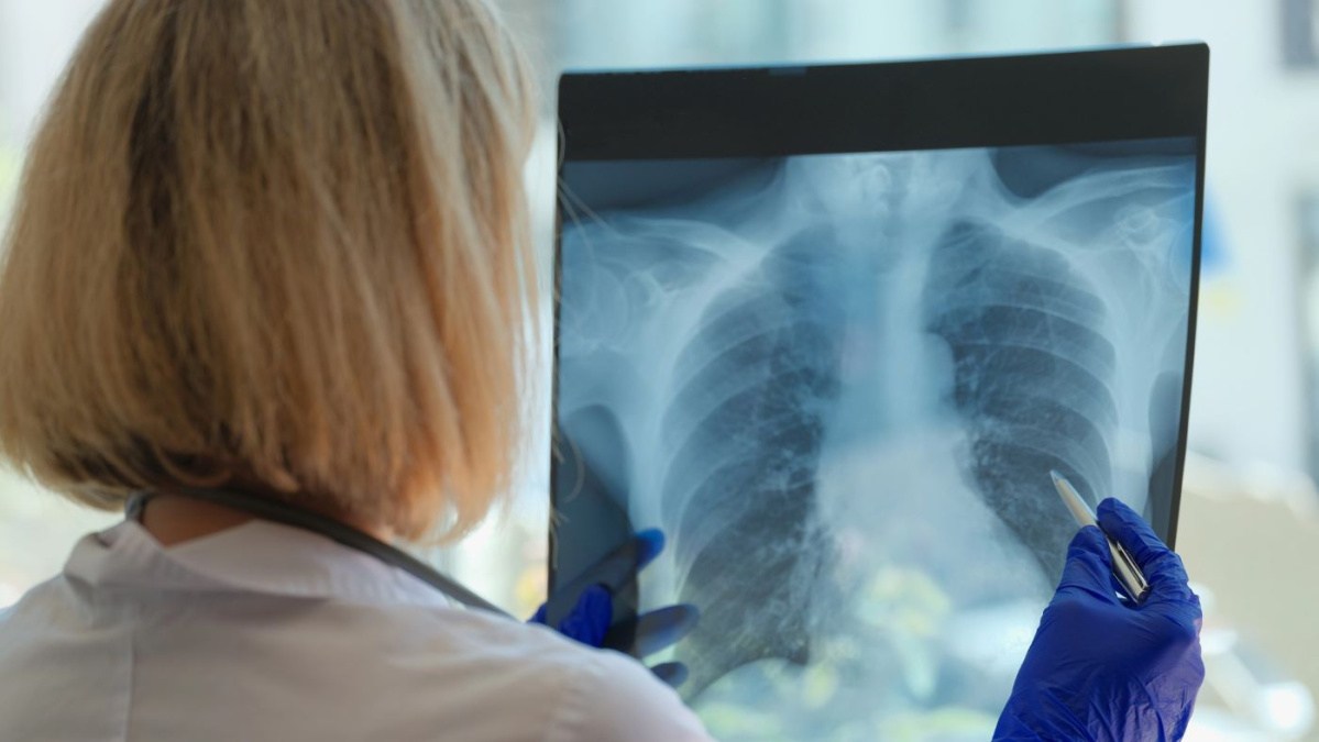 Incidența tuberculozei în UK, la cel mai ridicat nivel din ultimii 10 ani