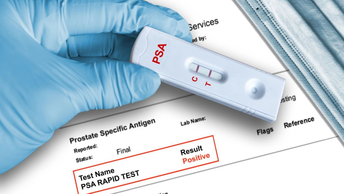 Explozie a numărului tineri diagnosticați cu cancer de prostată în UK